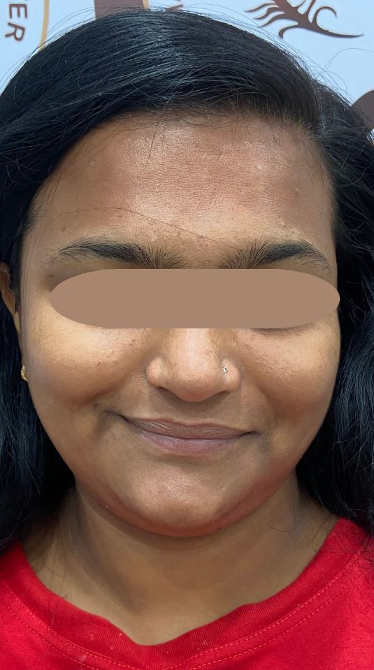 Before Skin Brightening